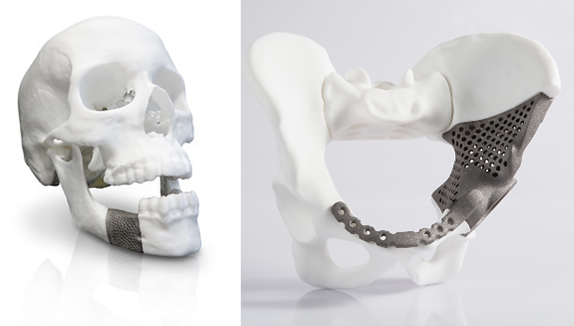 3D-gedruckte Metallbauteile für die Medizintechnik mittels Binder Jetting