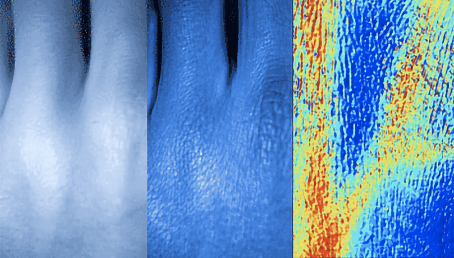 Strukturierte Beleuchtung und hyperspektrale Bildgebung ermöglichen objektive Hautkrebs-Früherkennung
